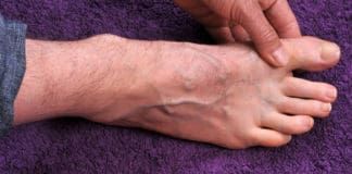 Gout Causes, Symptoms, and Treatment