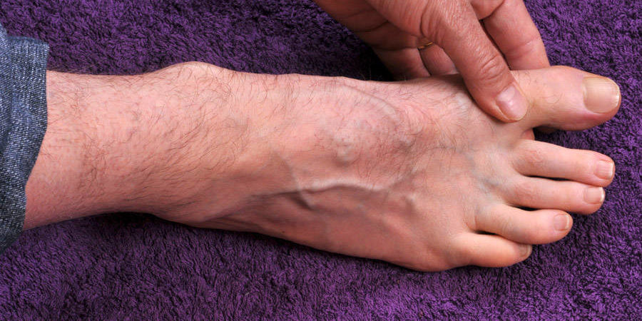 Gout Causes, Symptoms, and Treatment