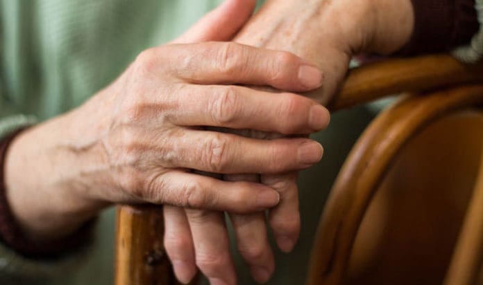 Woman's Hands Rheumatoid Arthritis