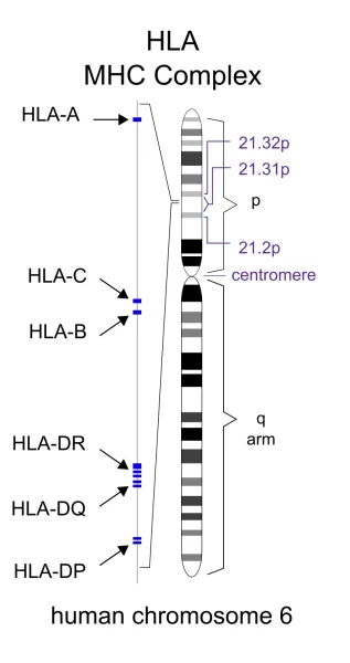 HLA region of chromosome 6: Changes in this area increase the probability of getting MS.