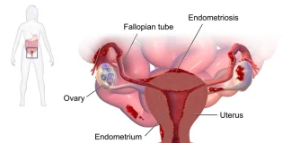 Drawing showing endometriosis