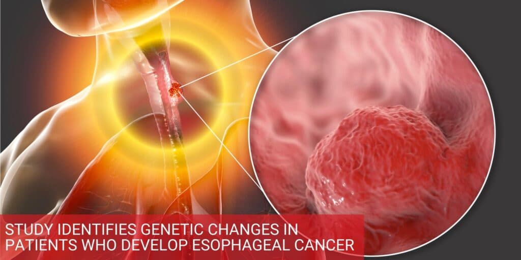 Study Identifies Genetic Changes in Patients Who Develop Esophageal Cancer