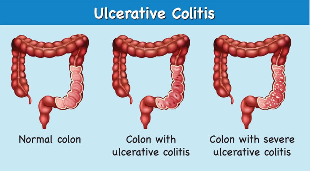 Ulcerative Colitis Infographic