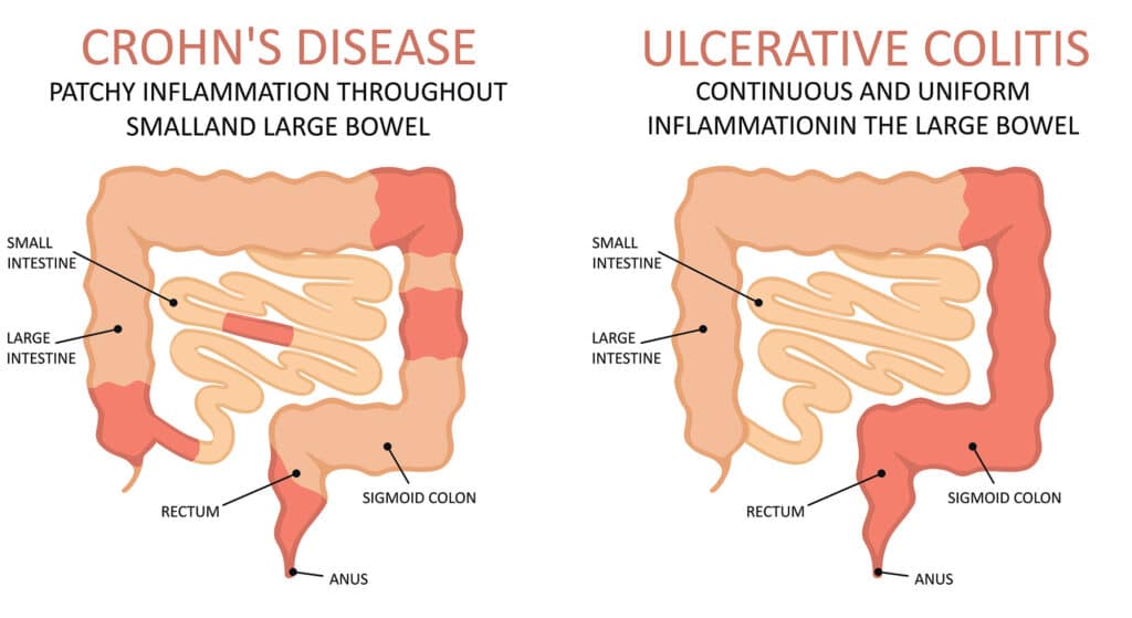 Types of Ulcerative Colitis