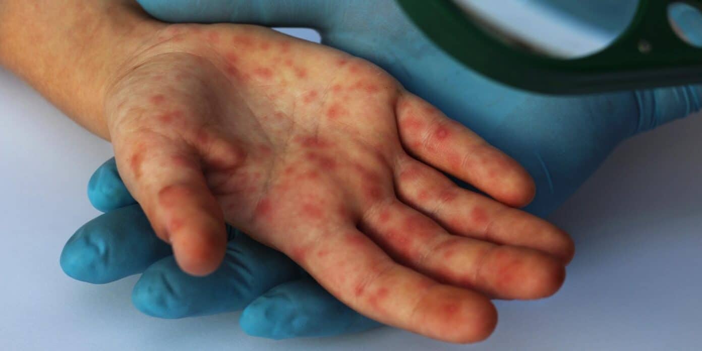 Monkeypox Detected in the UK: How to Spot the Signs - Pain Resource