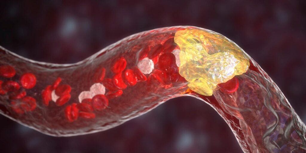 What Is Atherosclerosis?