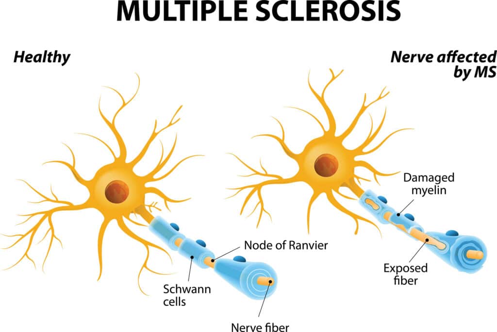 Multiple Sclerosis