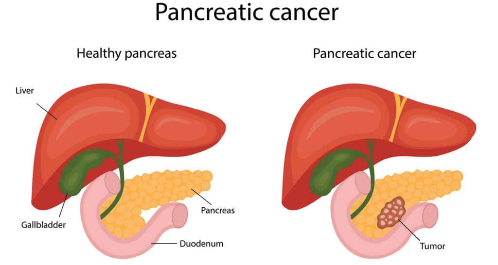 Pancreatic Cancer Infographic