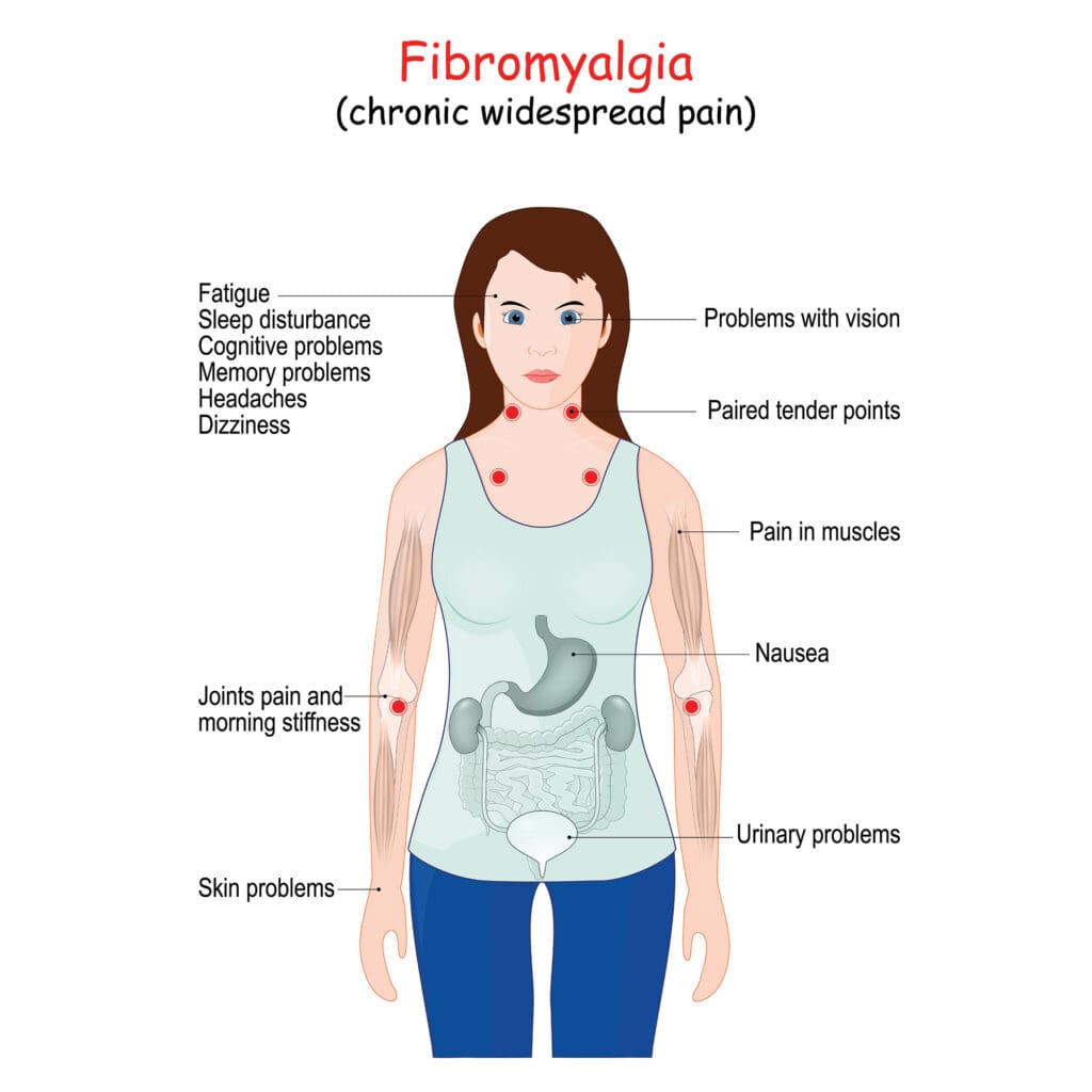 Symptoms of Fibromyalgia