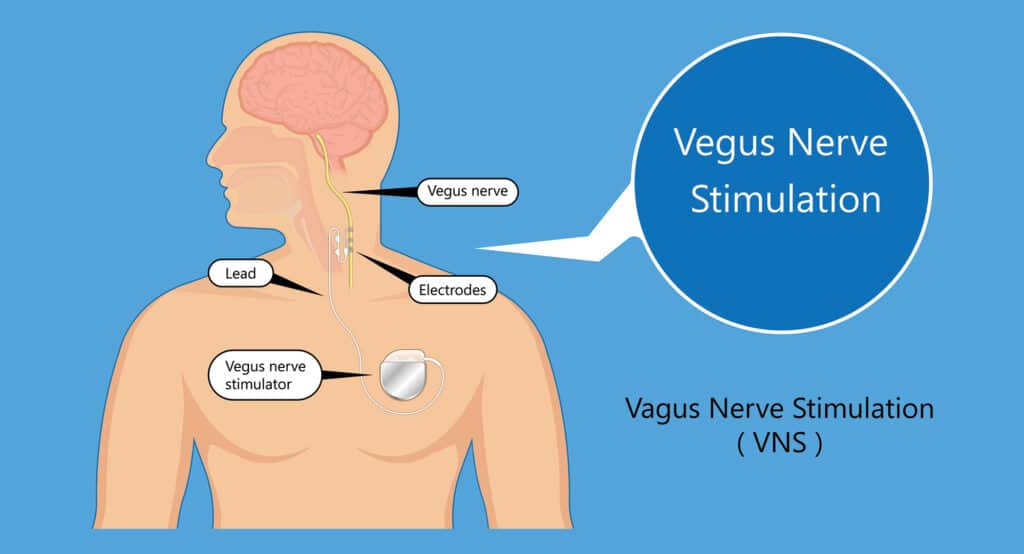 Vagus Nerve Stimulation Infographic