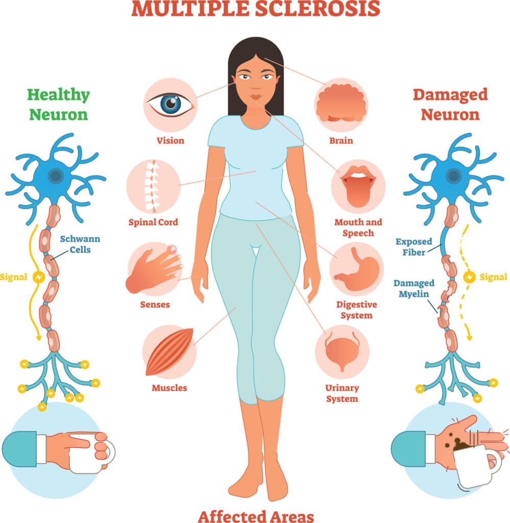 What is multiple sclerosis