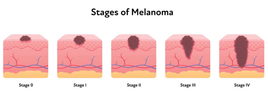 high-risk melanoma