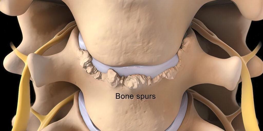 Bone Spurs Image