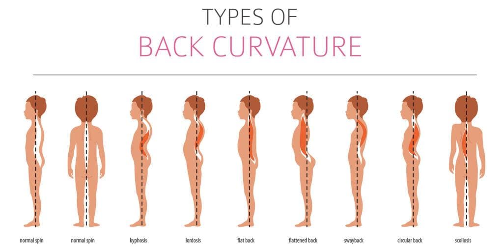 Lordosis Infographic