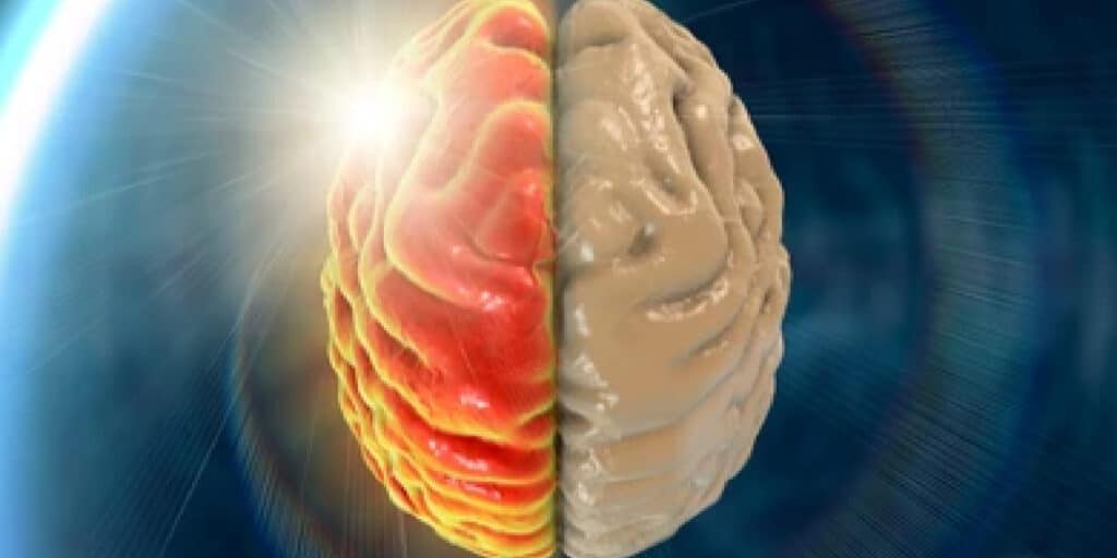 Migraine Aura Brain