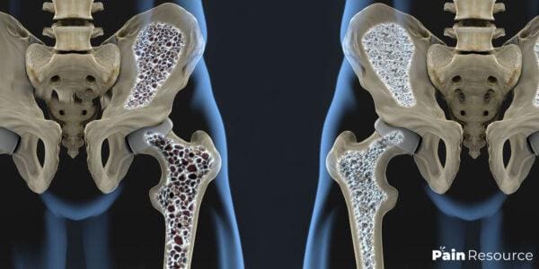 Illustration showing Osteoporosis on the human bone