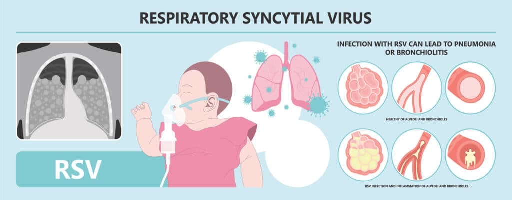 Respiratory Syncytial Virus Infographic