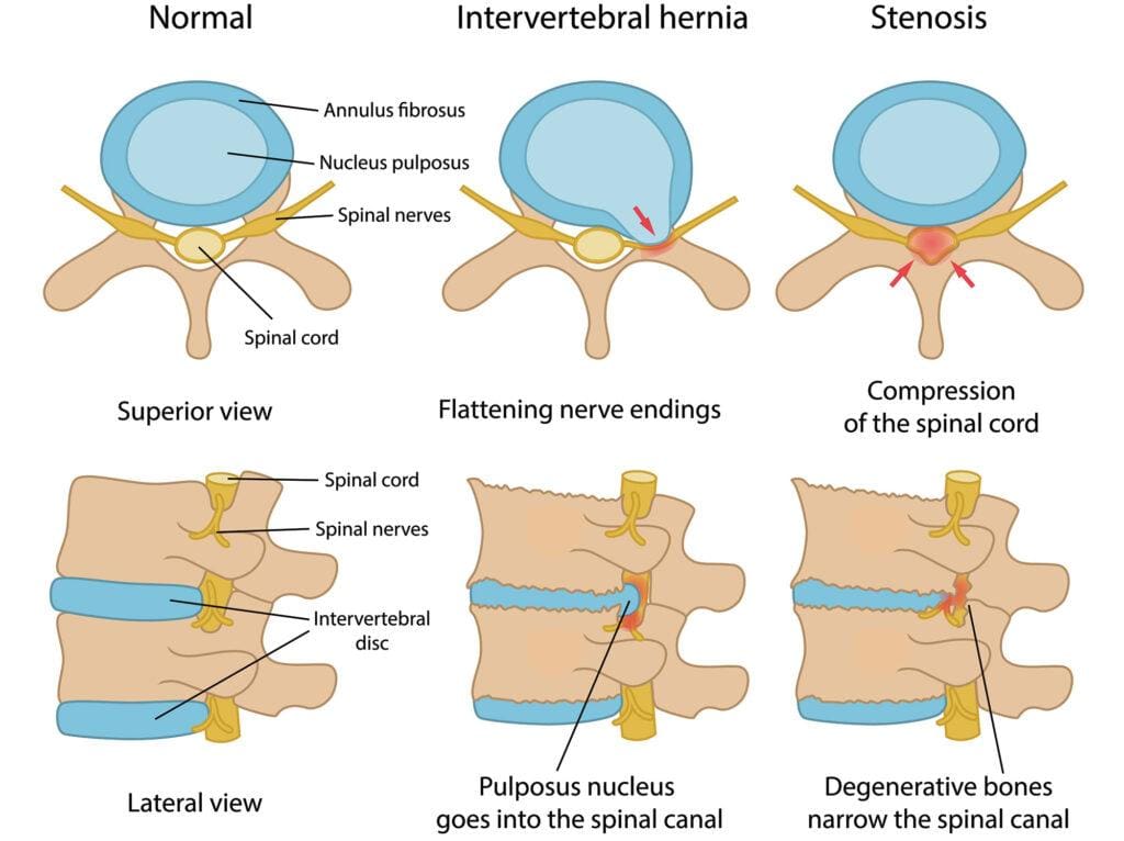 Spinal Stenosis Infographic