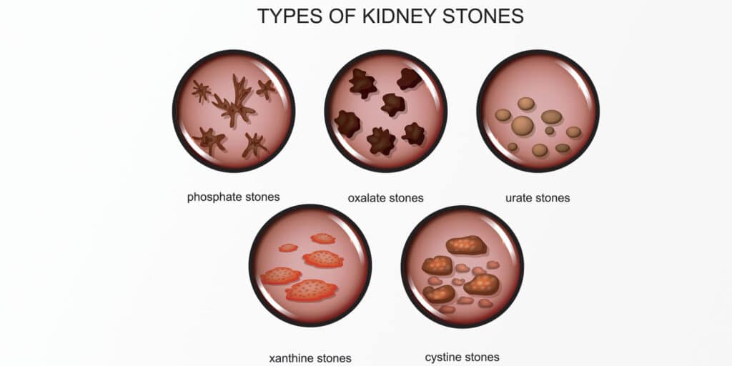 What Are Kidney Stones