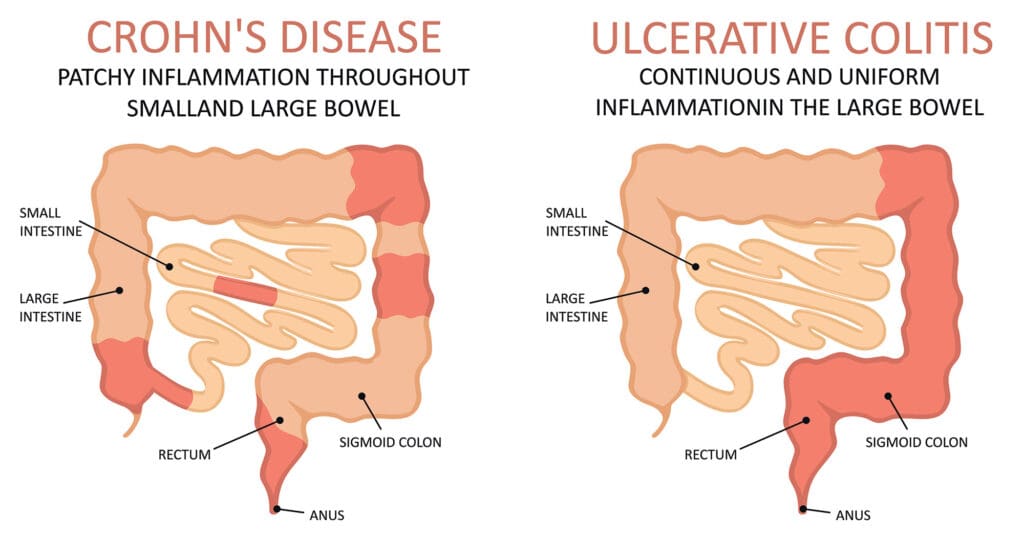 Crohn's and Colitis infographic