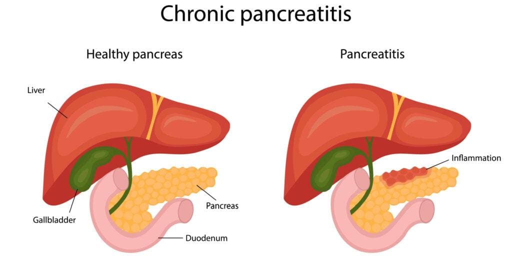 What Is Chronic Pancreatitis?