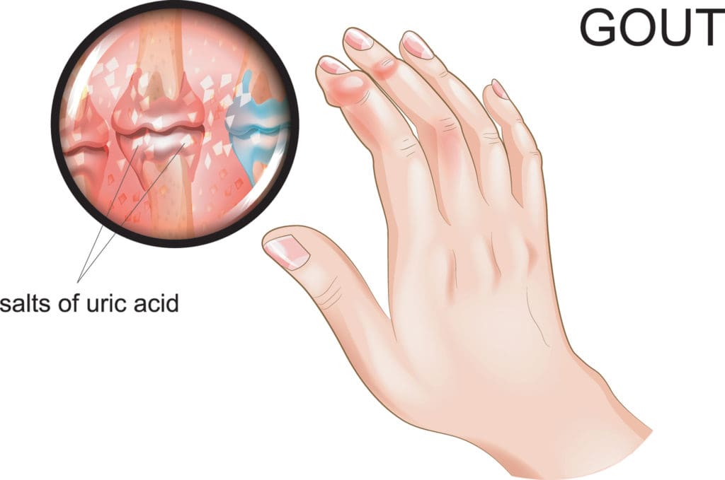 Gout Uric Acid