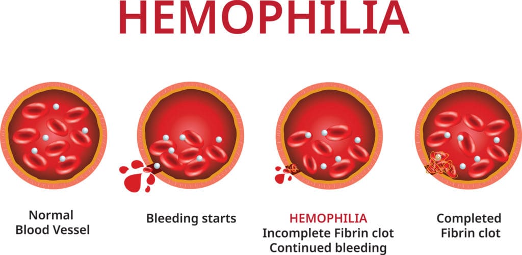 Hemophilia Bruise Easily