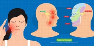 What is Trigeminal Neuralgia?