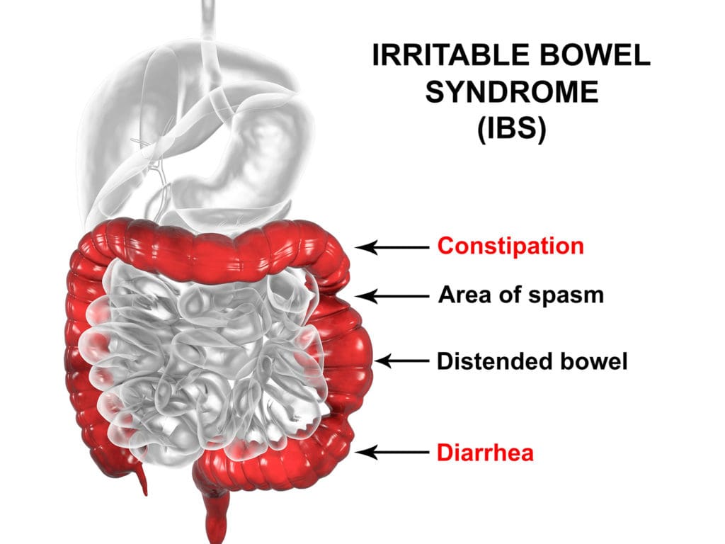 Symptoms and Causes of Irritable Bowel Syndrome