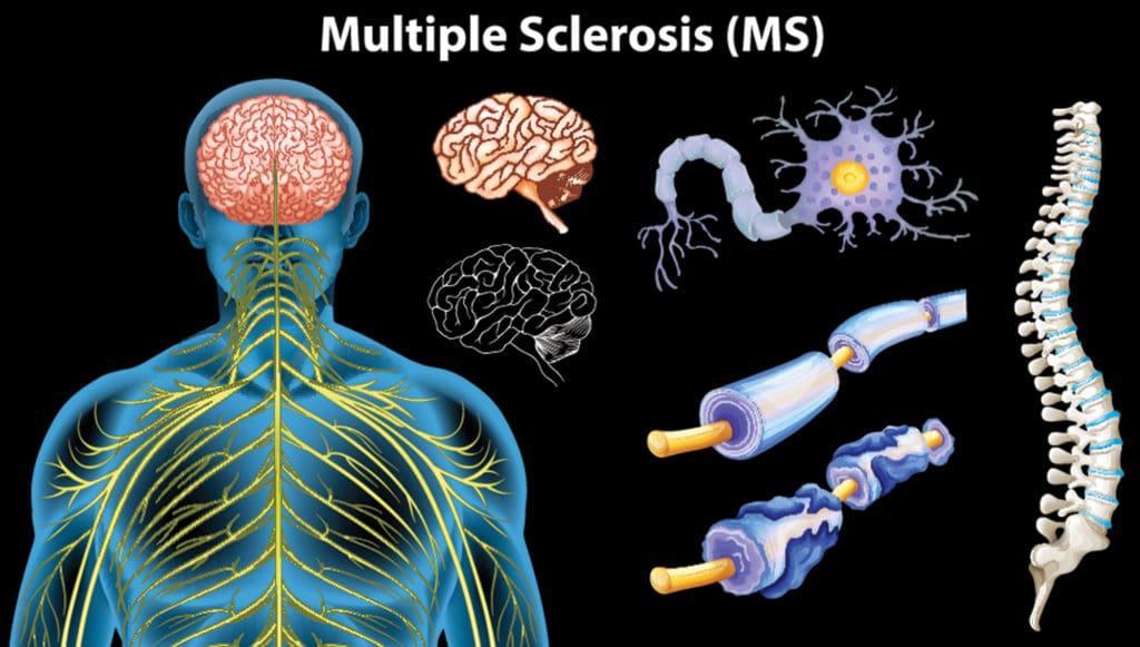 Neuropathic Pain Multiple Sclerosis
