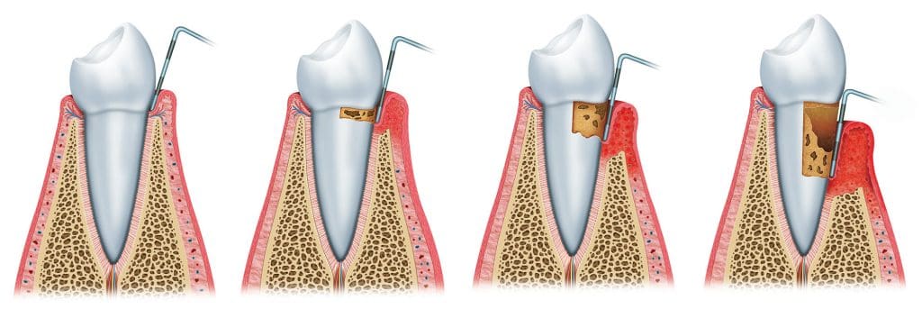 Periodontal disease