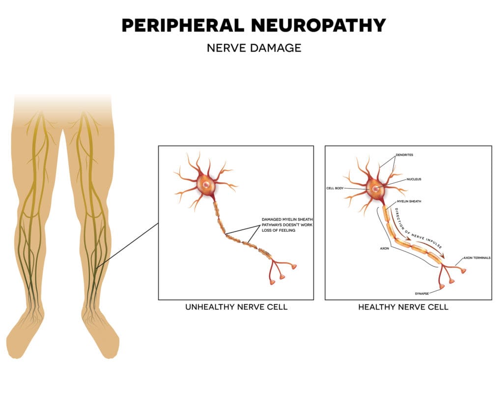 Peripheral Neuropathy Chart