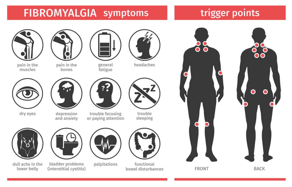 Signs of Fibromyalgia Chart