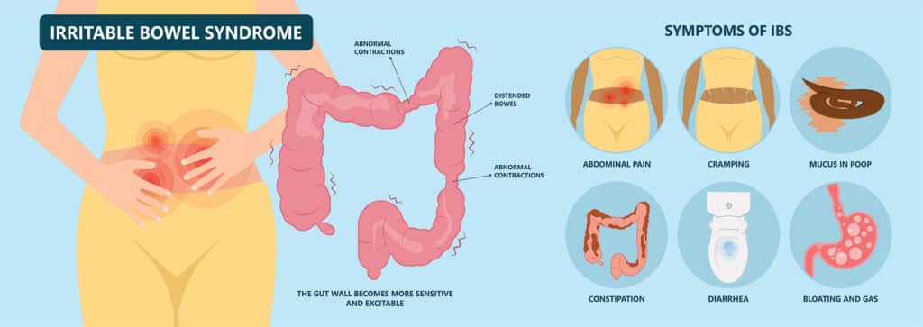 Symptoms of Irritable Bowel Syndrome