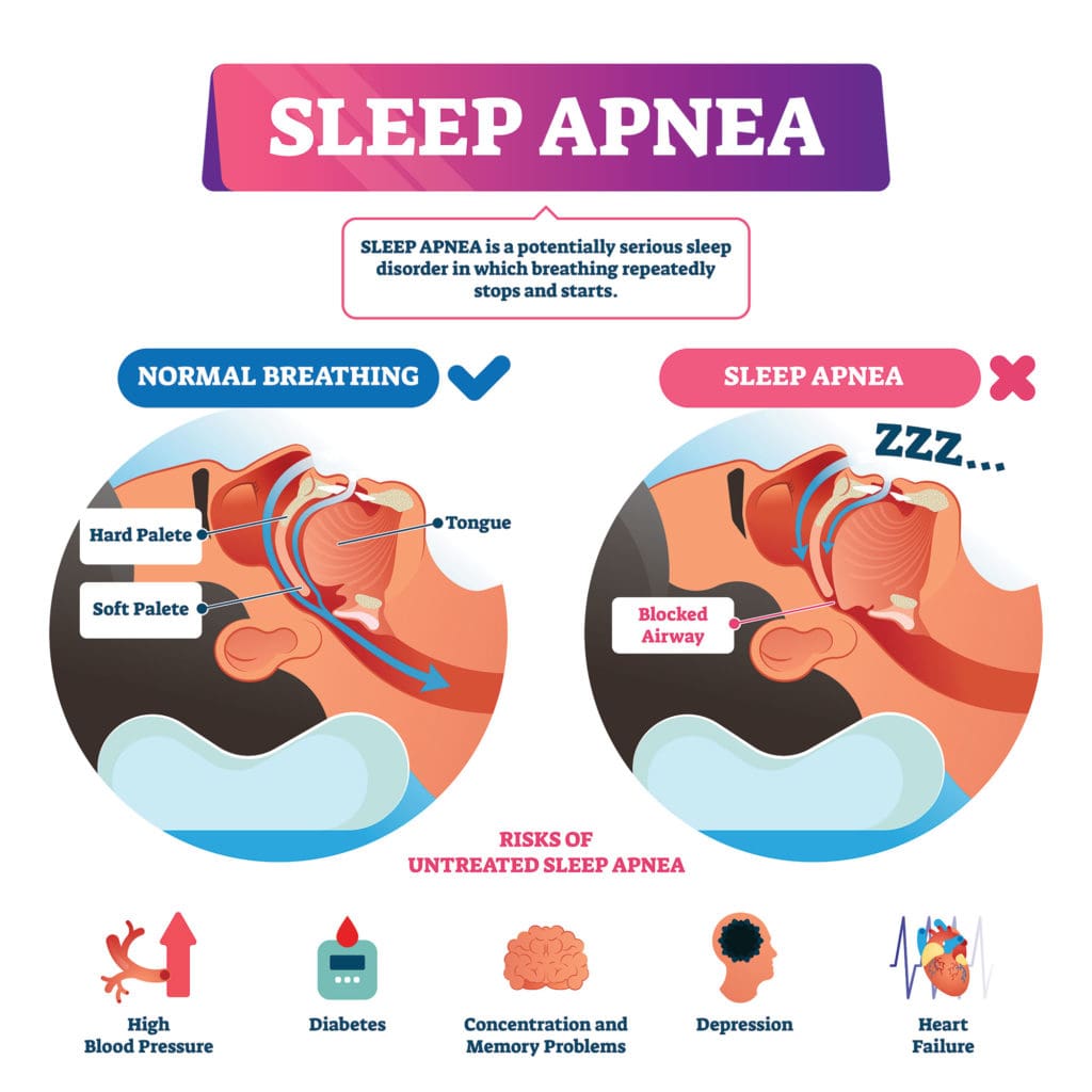 What Causes Sleep Apnea?