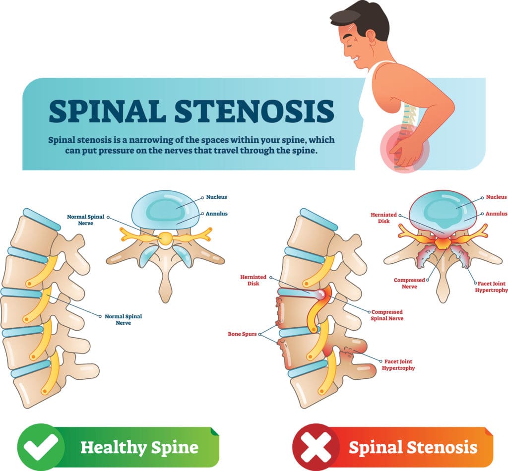 What Causes Spinal Stenosis