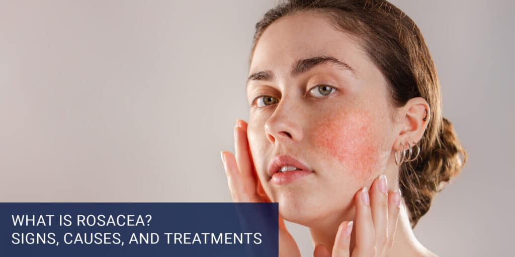 What Is Rosacea? Signs, Causes, and Treatments