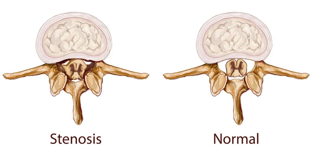 What Is Spinal Stenosis