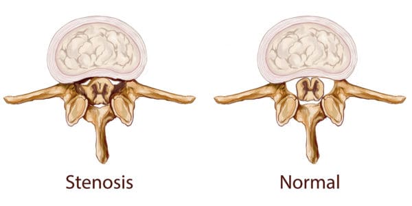 Could Spinal Stenosis Be Causing Your Chronic Back Pain?