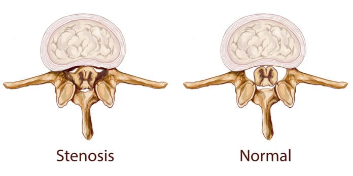 Could Spinal Stenosis Be Causing Your Chronic Back Pain?