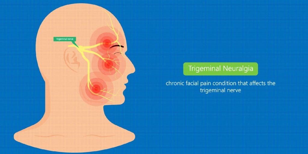 What does trigeminal neuralgia feel like?