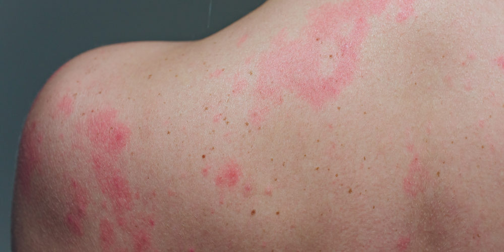 chronic skin rashes that itch