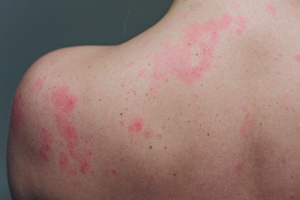 Chronic Conditions: What Is Autoimmune Disease Rash? | Pain Resource