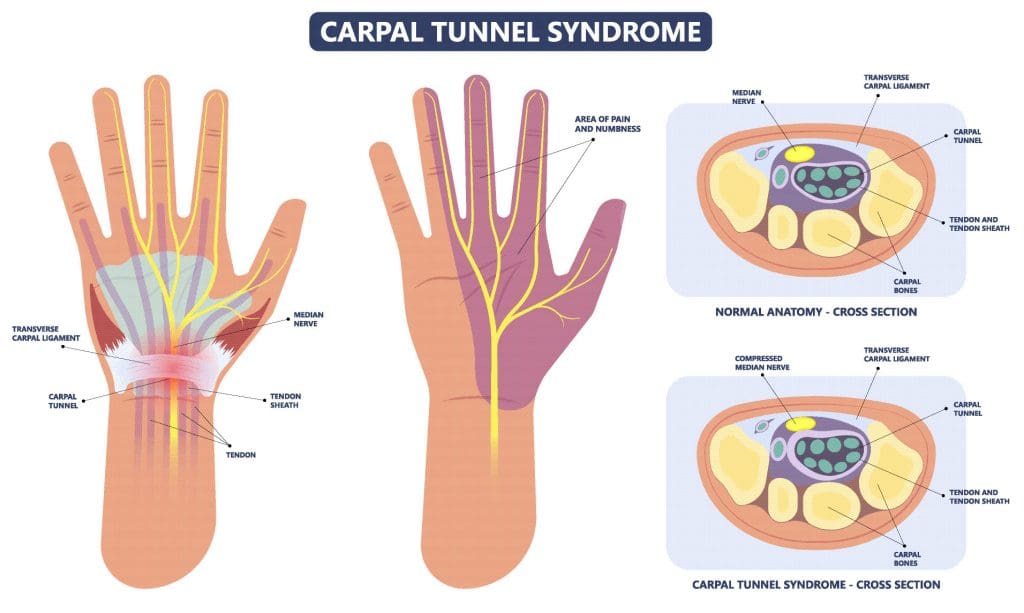 carpal tunnel syndrome infographic