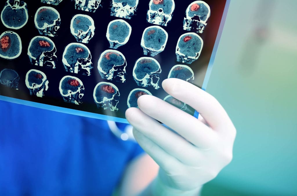new brain implant for Parkinson's Disease