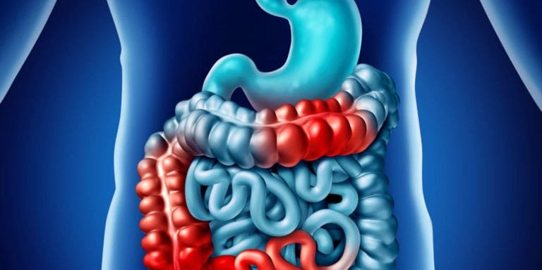 Complications and Conditions Caused By Crohn’s Disease