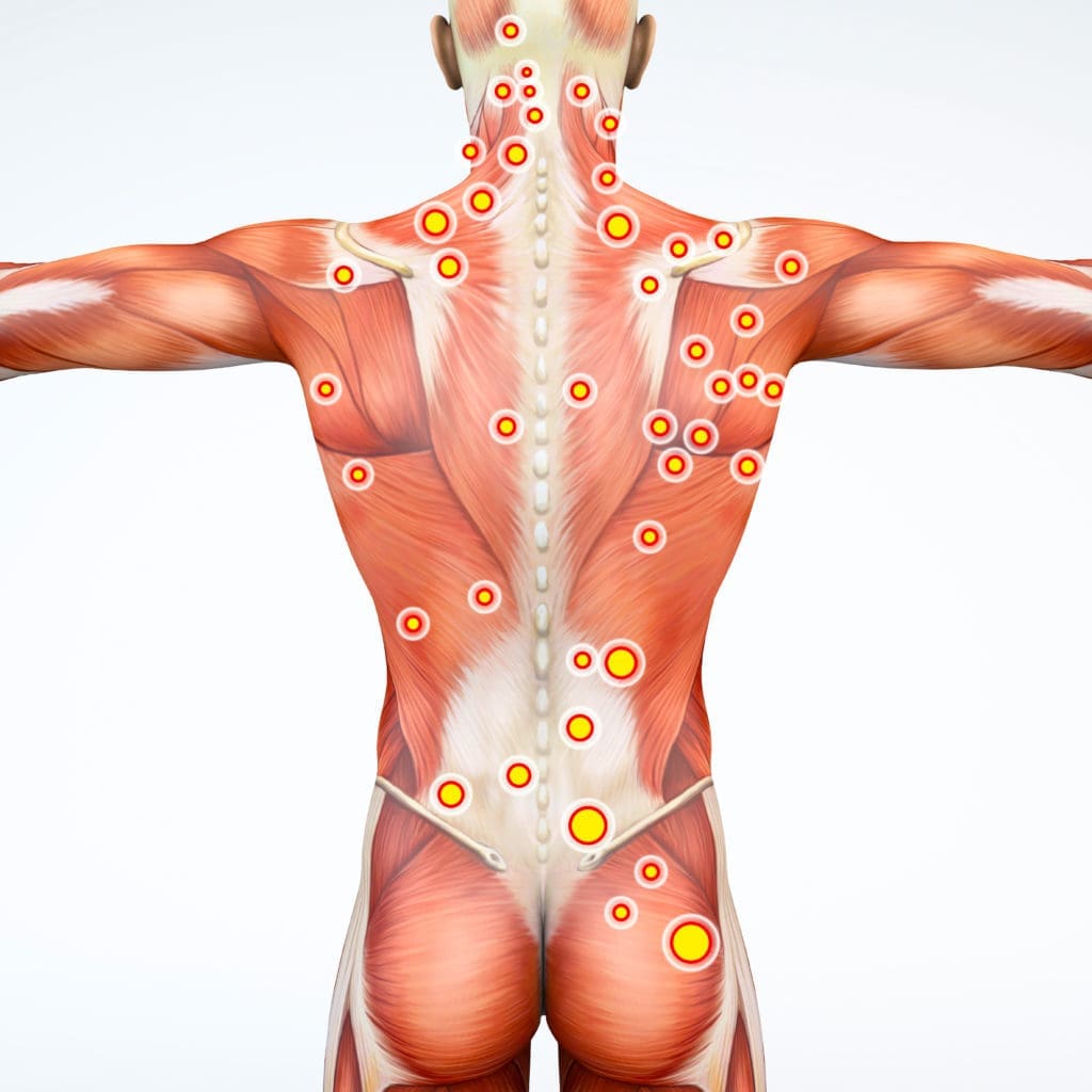 Myofascial trigger points 101