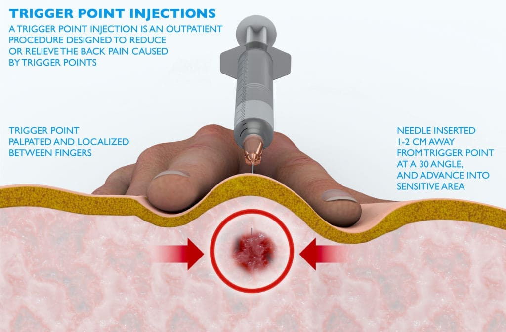 How Fibromyalgia Trigger Points Injections Work