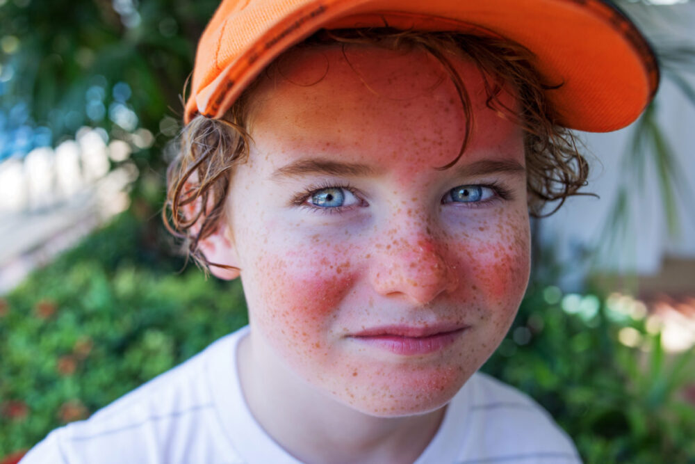 protect your skin from sunburn young boy with sunburn on his face