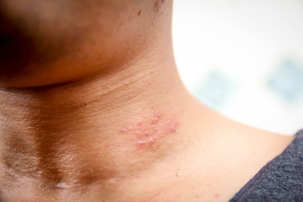 what you should know about shingles pain